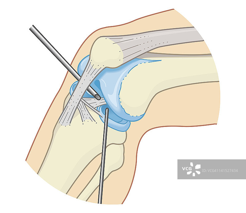 膝关节刚性内窥镜手术内部的生物医学横截面图图片素材