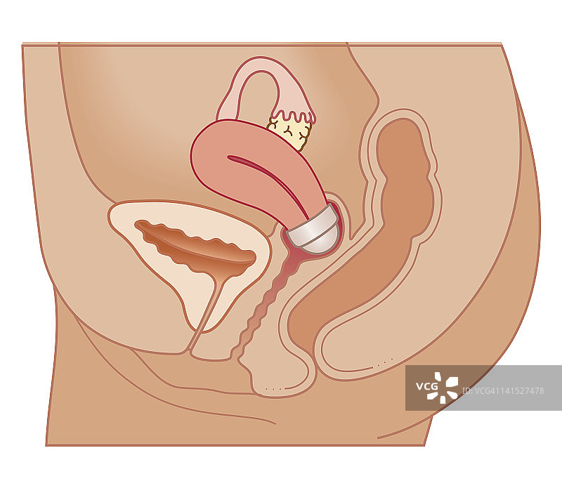 子宫帽位置的生物医学横截面图解图片素材
