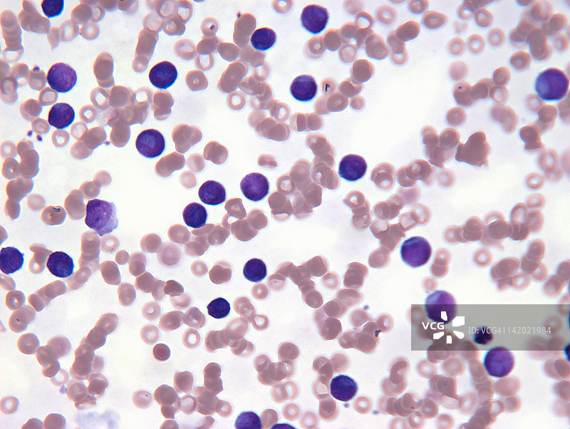 血液中的肿瘤淋巴细胞图片素材