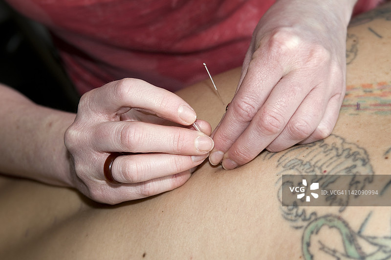 针灸师为男人背部施针图片素材