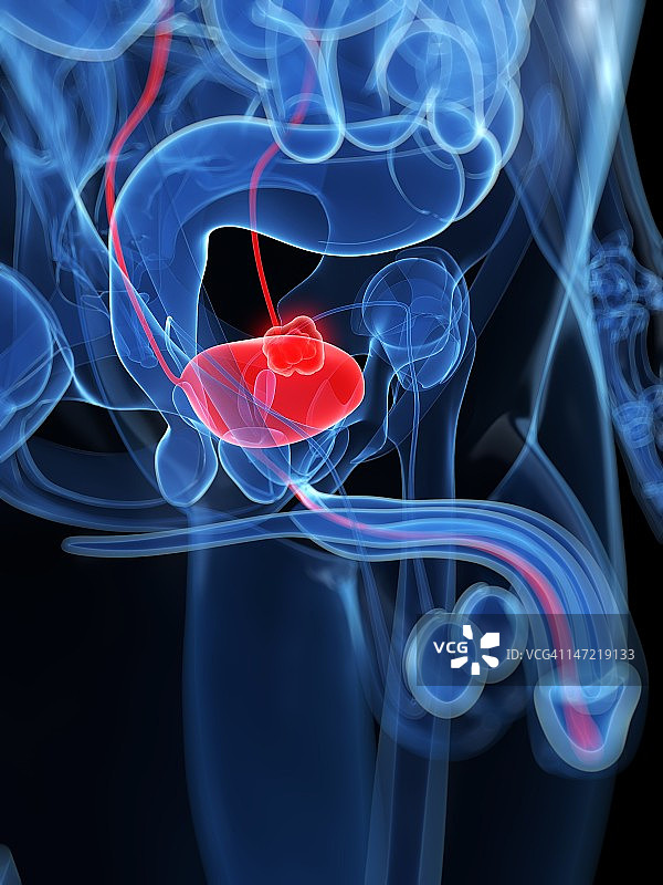 膀胱癌艺术图图片素材