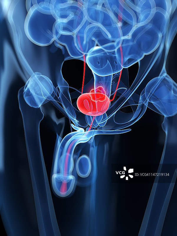 膀胱癌艺术图图片素材