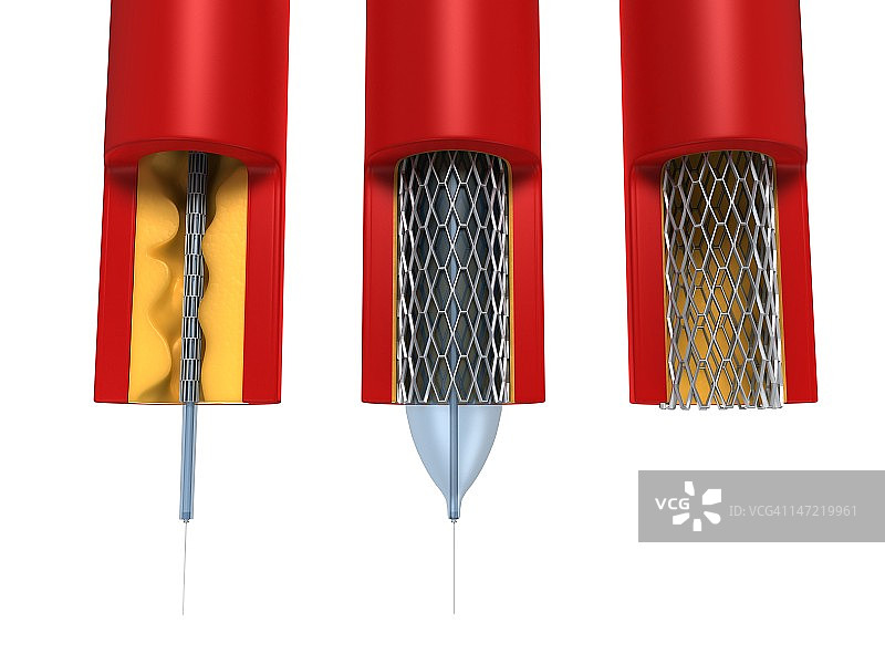 球囊血管成形术图片素材