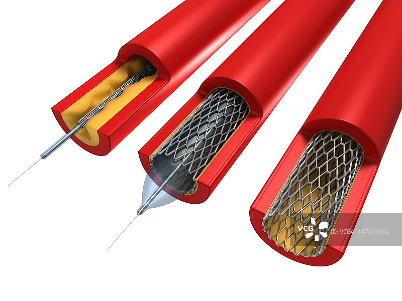 球囊血管成形术图片素材