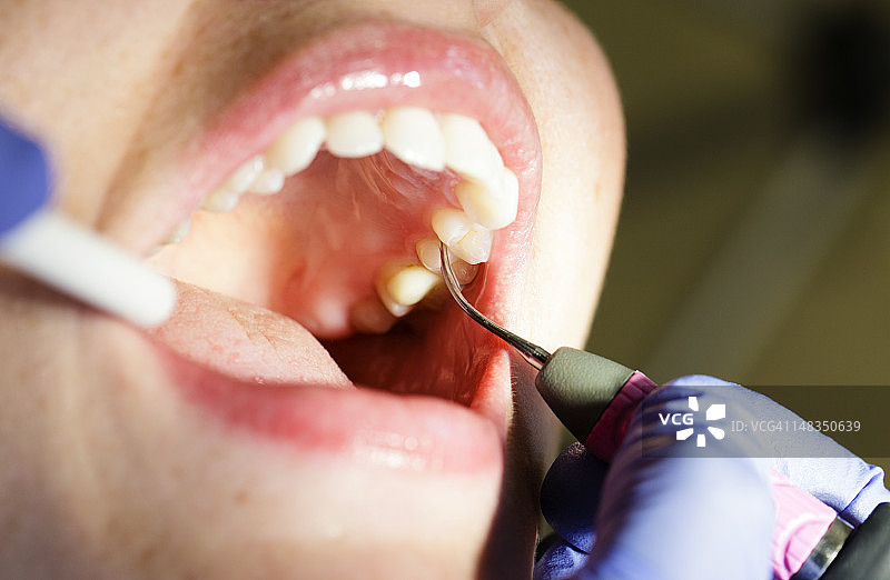 牙科清洁特写图片素材