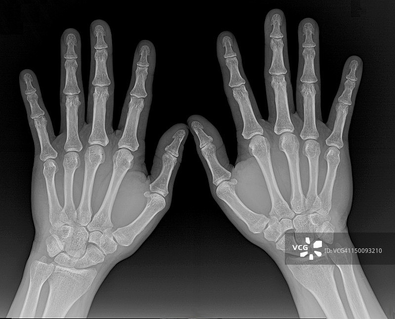 男性手部X光片图片素材