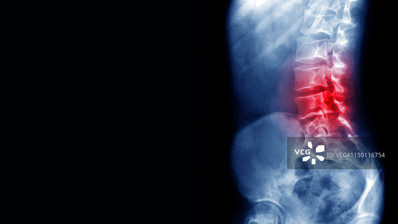 背痛X光片图片素材