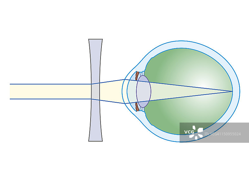 用于矫正近视的晶状体生物医学截面图图片素材