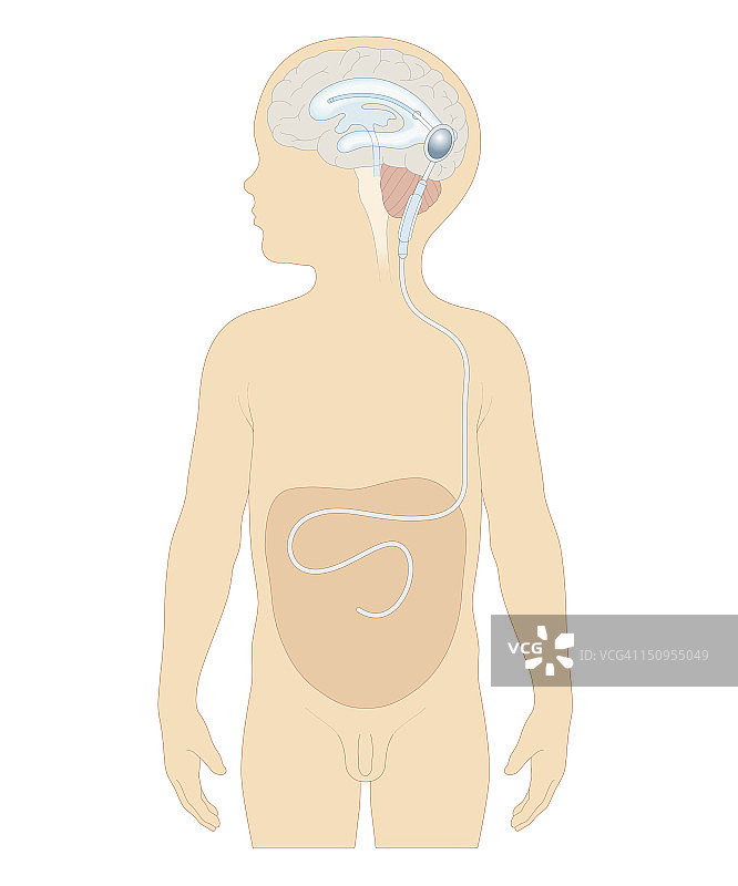 脑室分流术生物医学横截面图：将带有阀门的脑室分流器插入男孩大脑，以去除过多的脑脊液，并通过导管输送到胃部图片素材