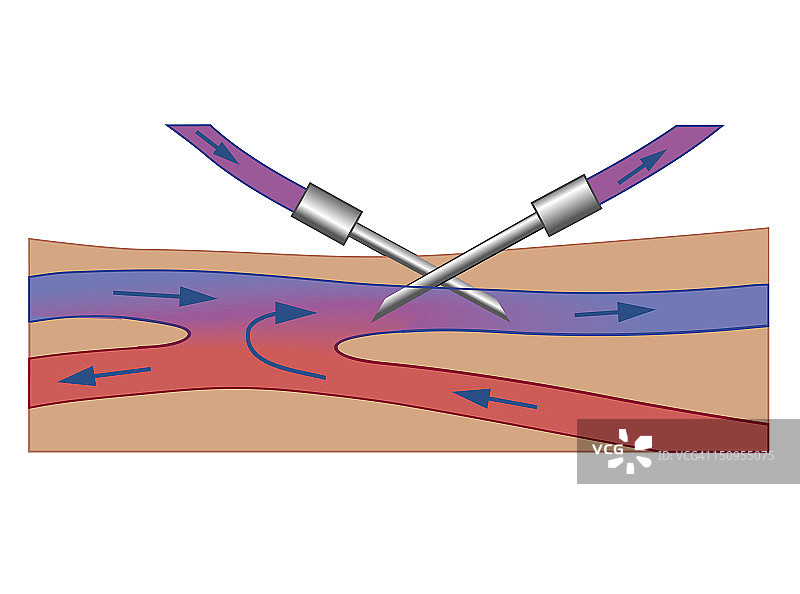 血液透析生物医学横截面图：针头插入静脉，透析液与血流方向相反图片素材