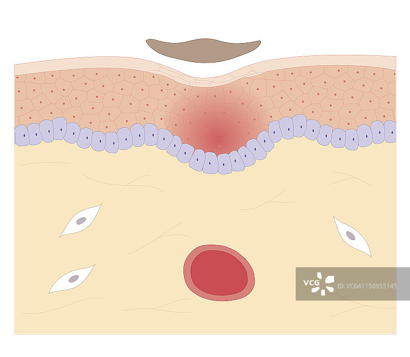 皮肤修复过程生物医学横截面图：纤维栓硬化成痂，新皮肤生长完成后脱落图片素材