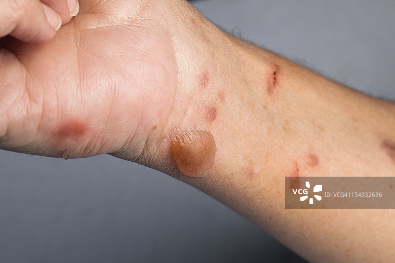 手臂二级烧伤的女人图片素材