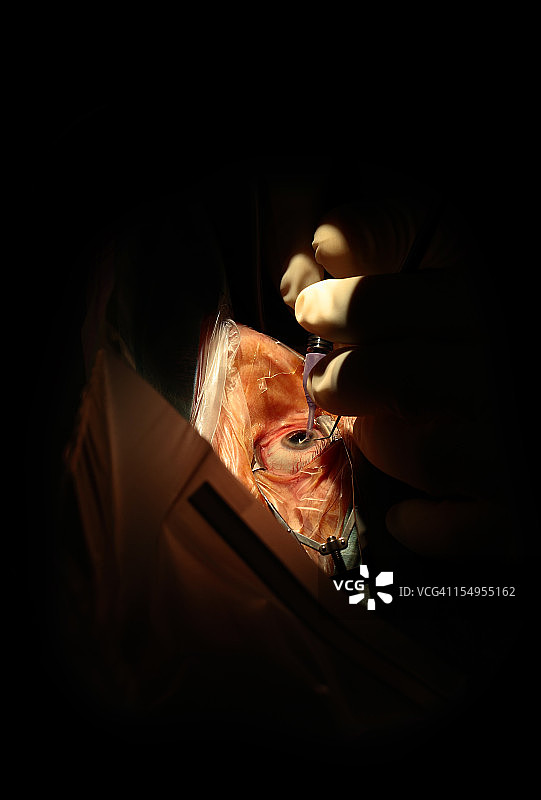 眼科手术：白内障图片素材