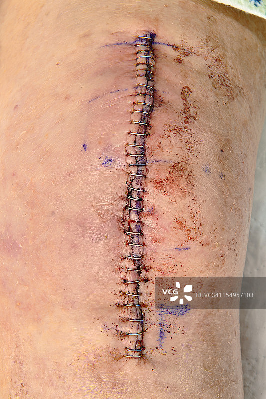 膝关节置换切口图片素材