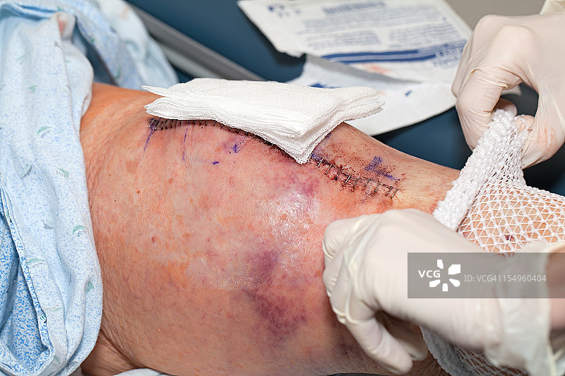 膝关节置换绷带图片素材