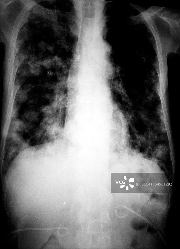癌症患者的肺部X光片图片素材