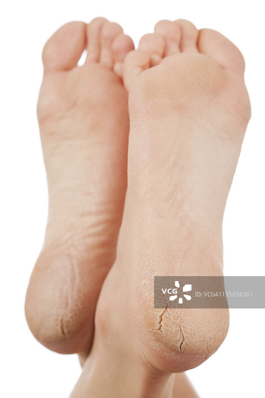 白色背景上干燥开裂的脚底图片素材