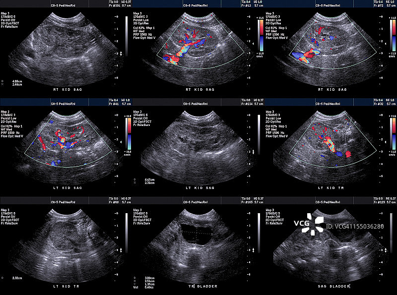新生儿肾脏和膀胱超声图片素材