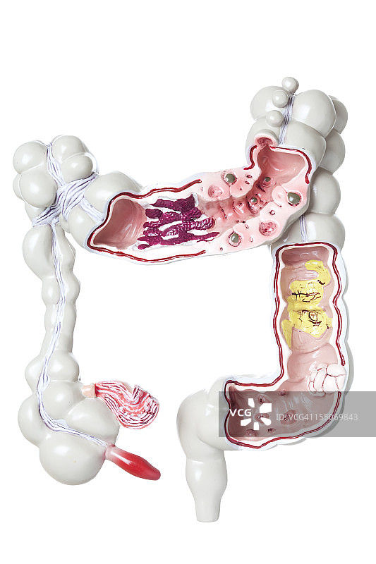 具有病理的大肠图片素材