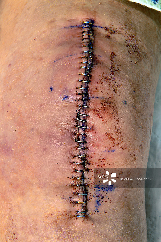 膝关节置换切口图片素材