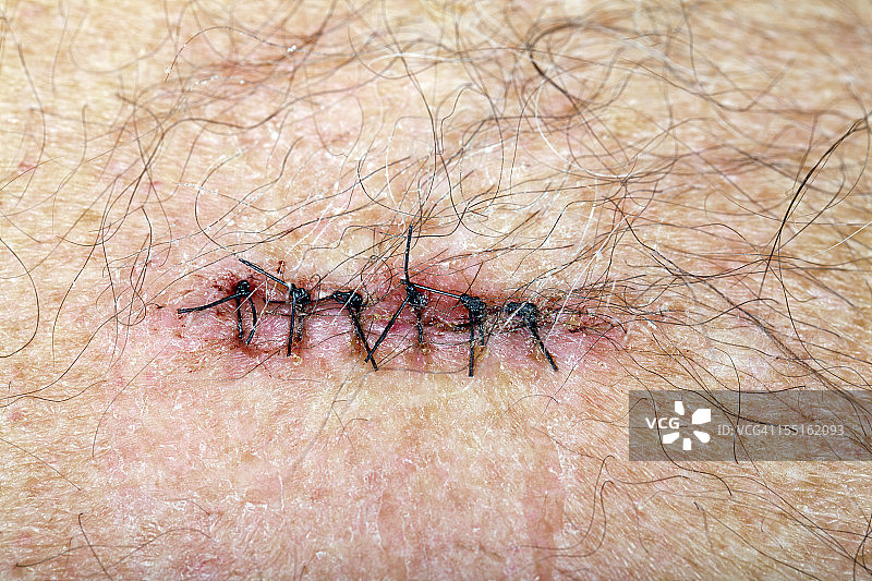 缝合的基底细胞癌切除切口图片素材