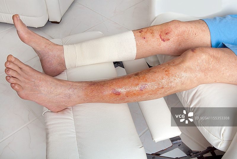 医疗：皮肤薄弱的老年人受伤图片素材