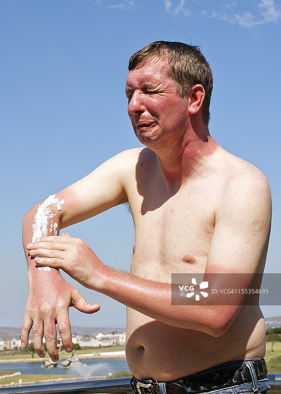 皮肤烧伤图片素材