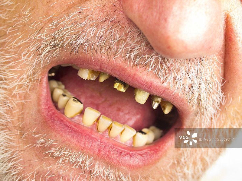 糟糕的牙齿图片素材