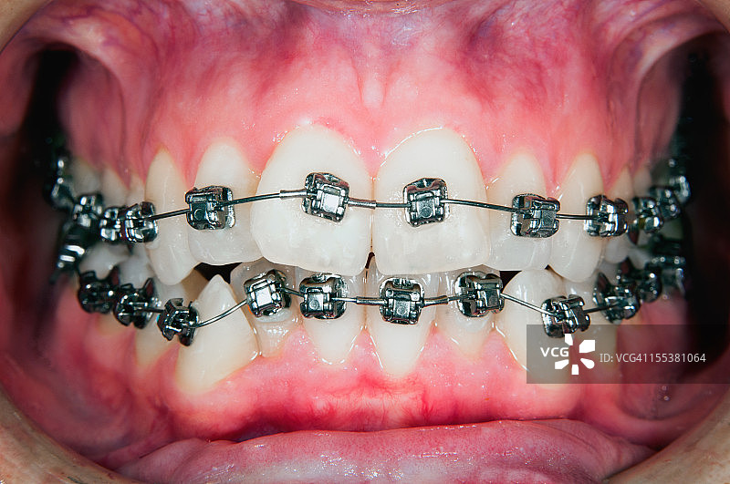 牙龈萎缩的正畸治疗图片素材