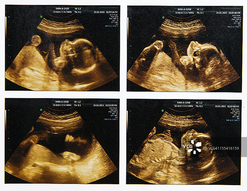 四胞胎胎儿超声波合集图片素材