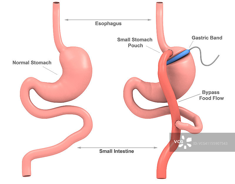 乐队胃旁路手术（3D）图片素材