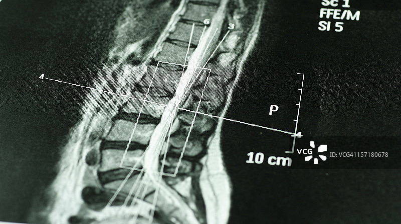 10厘米比例的计算机断层扫描图像图片素材