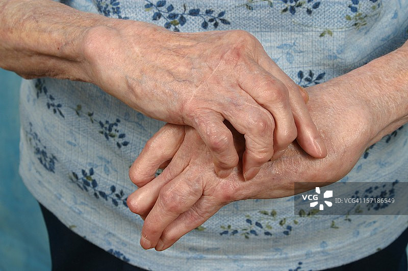 关节炎手部正面图图片素材