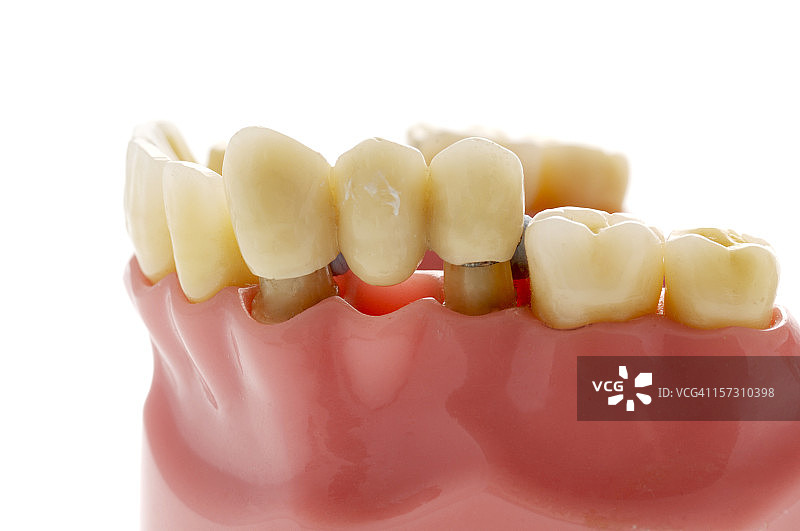 用于替代缺失牙齿的牙桥模型图片素材