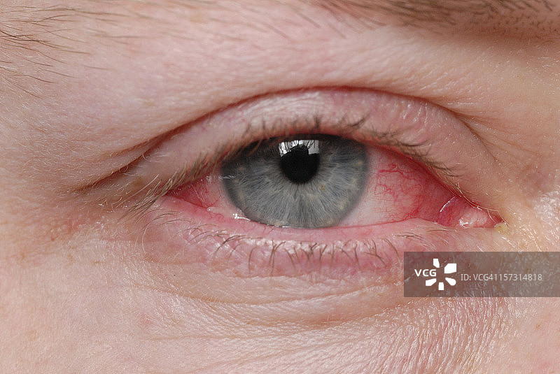 红眼病图片素材