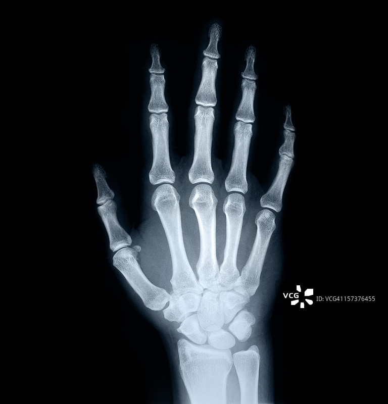 人手的X光片图片素材