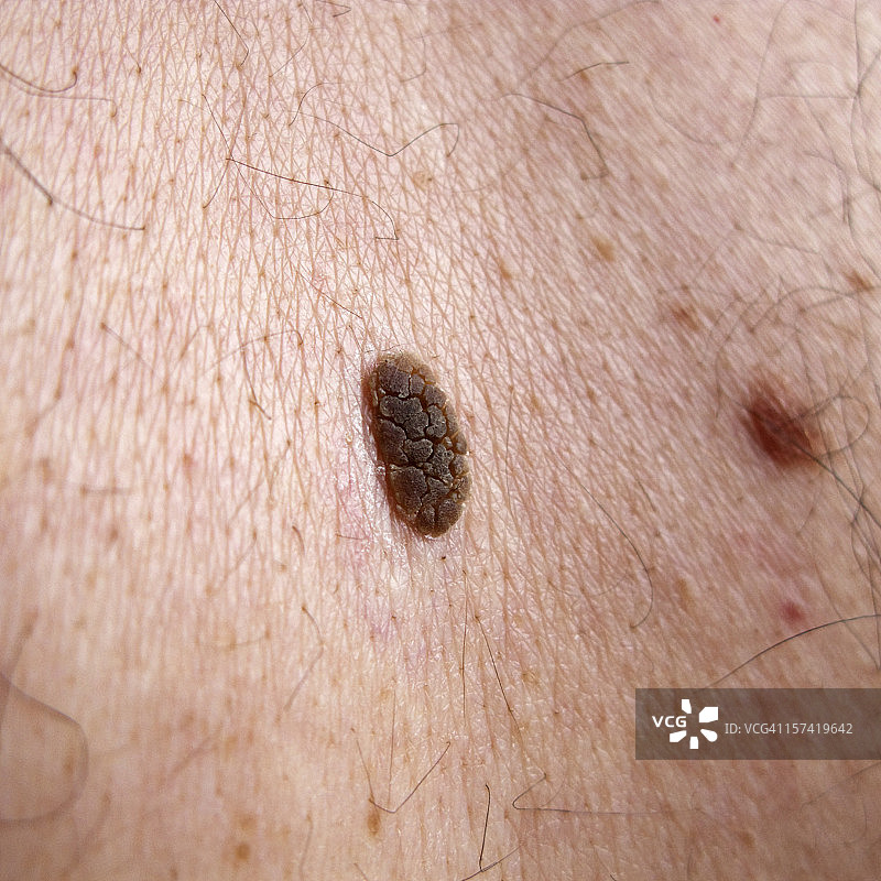 脂溢性角化病图片素材