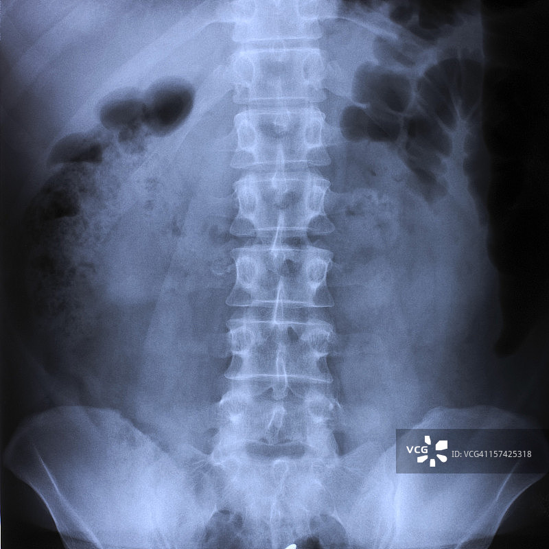 人体脊柱X光片图片素材