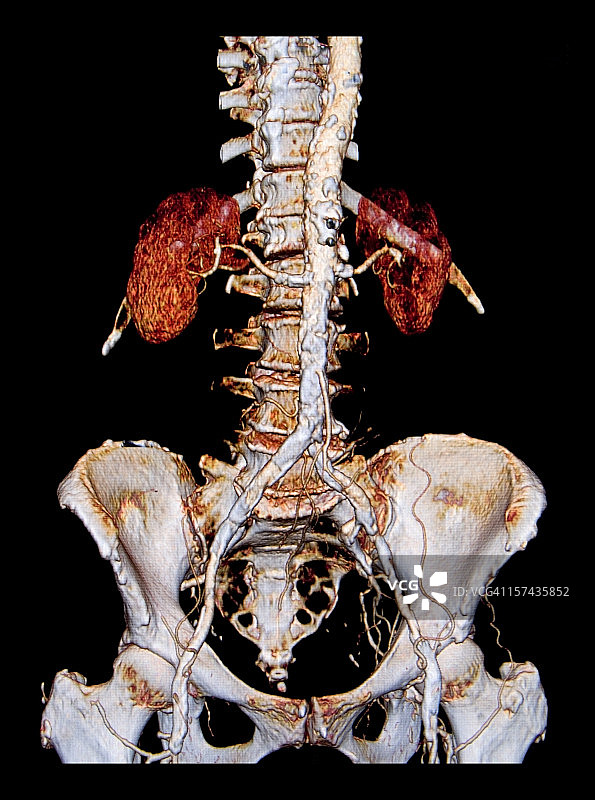 显示广泛动脉粥样硬化的3D腹主动脉CAT扫描图片素材
