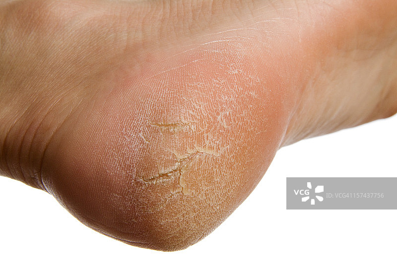 白色背景上干燥且龟裂的女性脚后跟图片素材