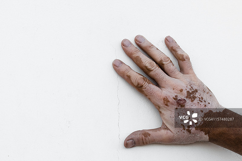 患有白癜风的男人手部，白色背景图片素材