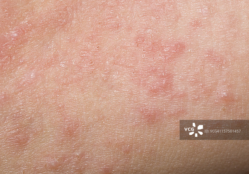 儿童的红色皮疹，有肿块、结痂和丘疹图片素材