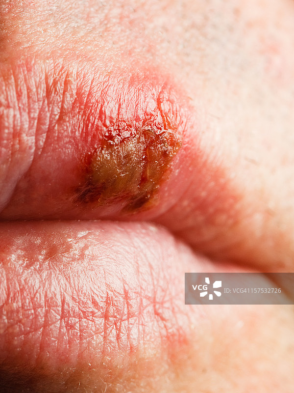 唇疱疹图片素材