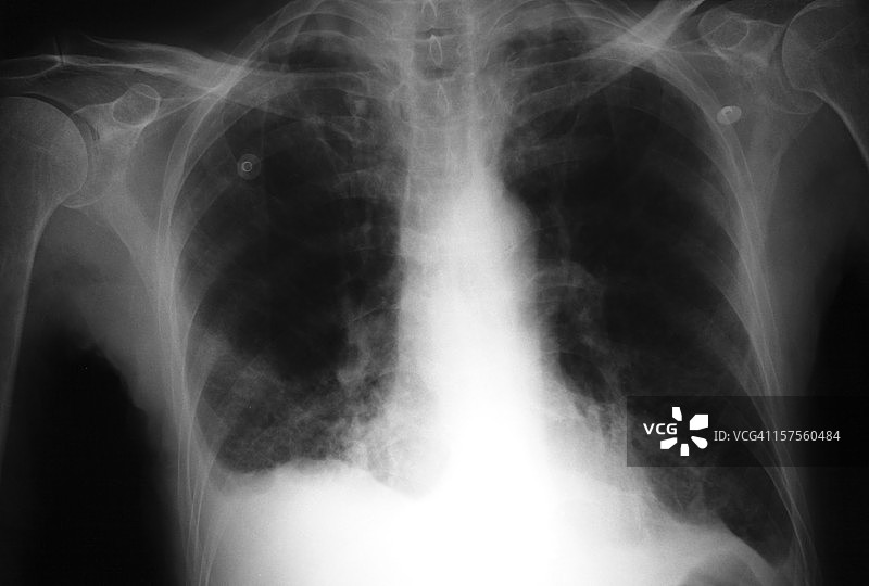 支气管炎肺部的X光片图片素材