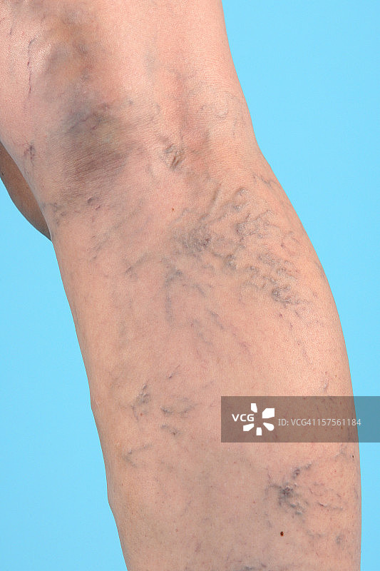 腿上的静脉曲张图片素材