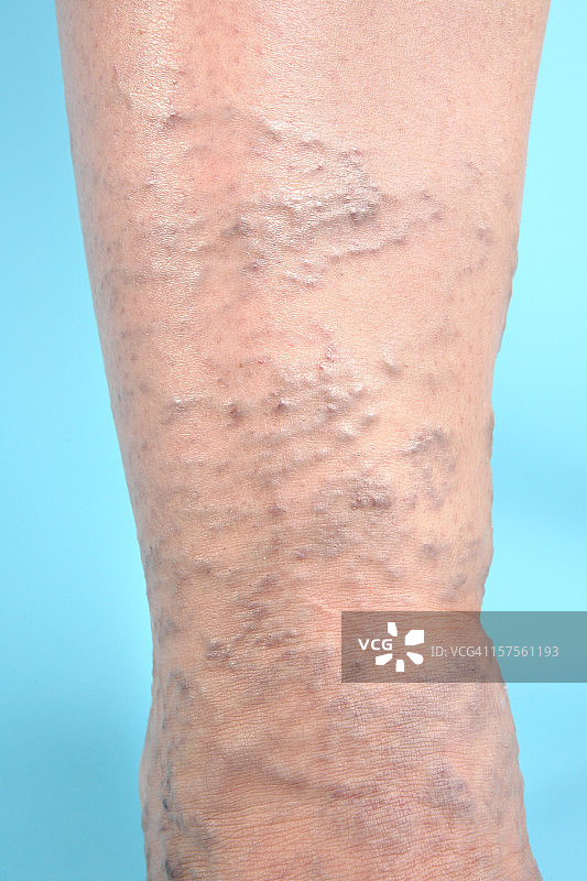 腿上的静脉曲张图片素材