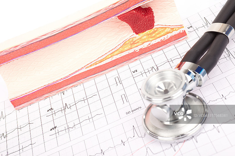动脉硬化、心电图和听诊器模型图片素材