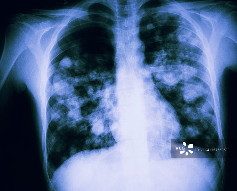 H7N9禽流感疑似肺部X光片图片素材