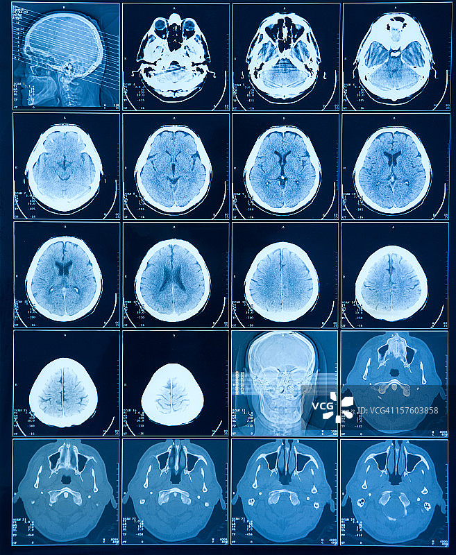 MRI脑部扫描图片素材