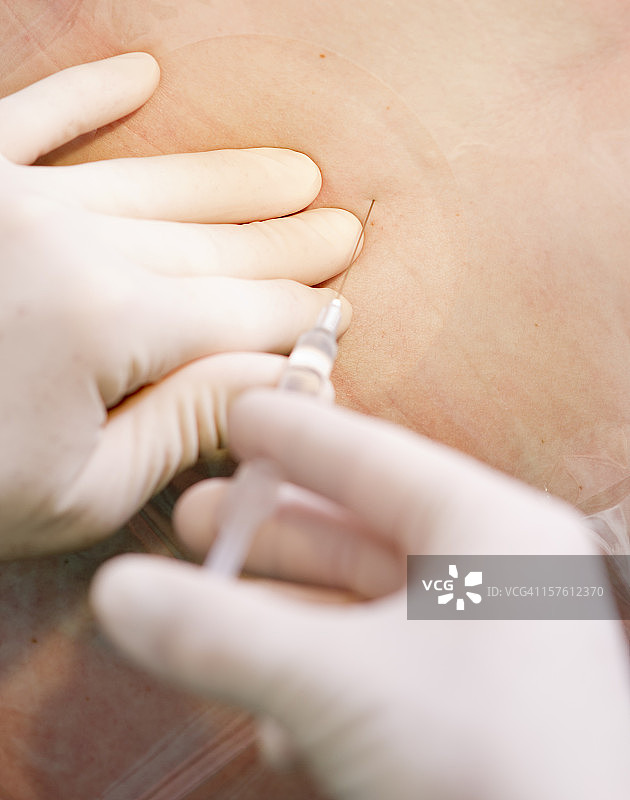 硬膜外麻醉图片素材